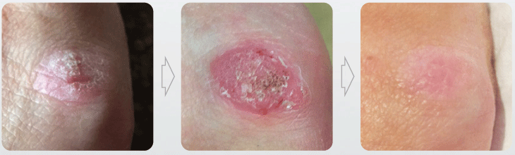 E11 CRYOTHERAPY WART