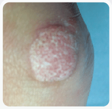 CRYOTHERAPY WART Wanstead