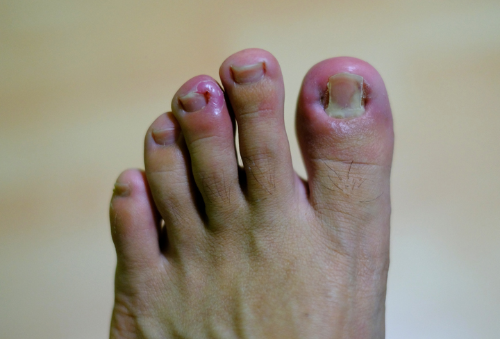 Ingrowing toenail Golders Green